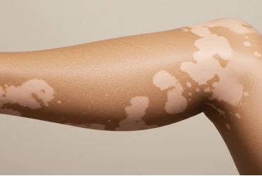 Homeopathic Treatment for Vitiligo — Dr. Manish Yadav, Sevatwa Clinic