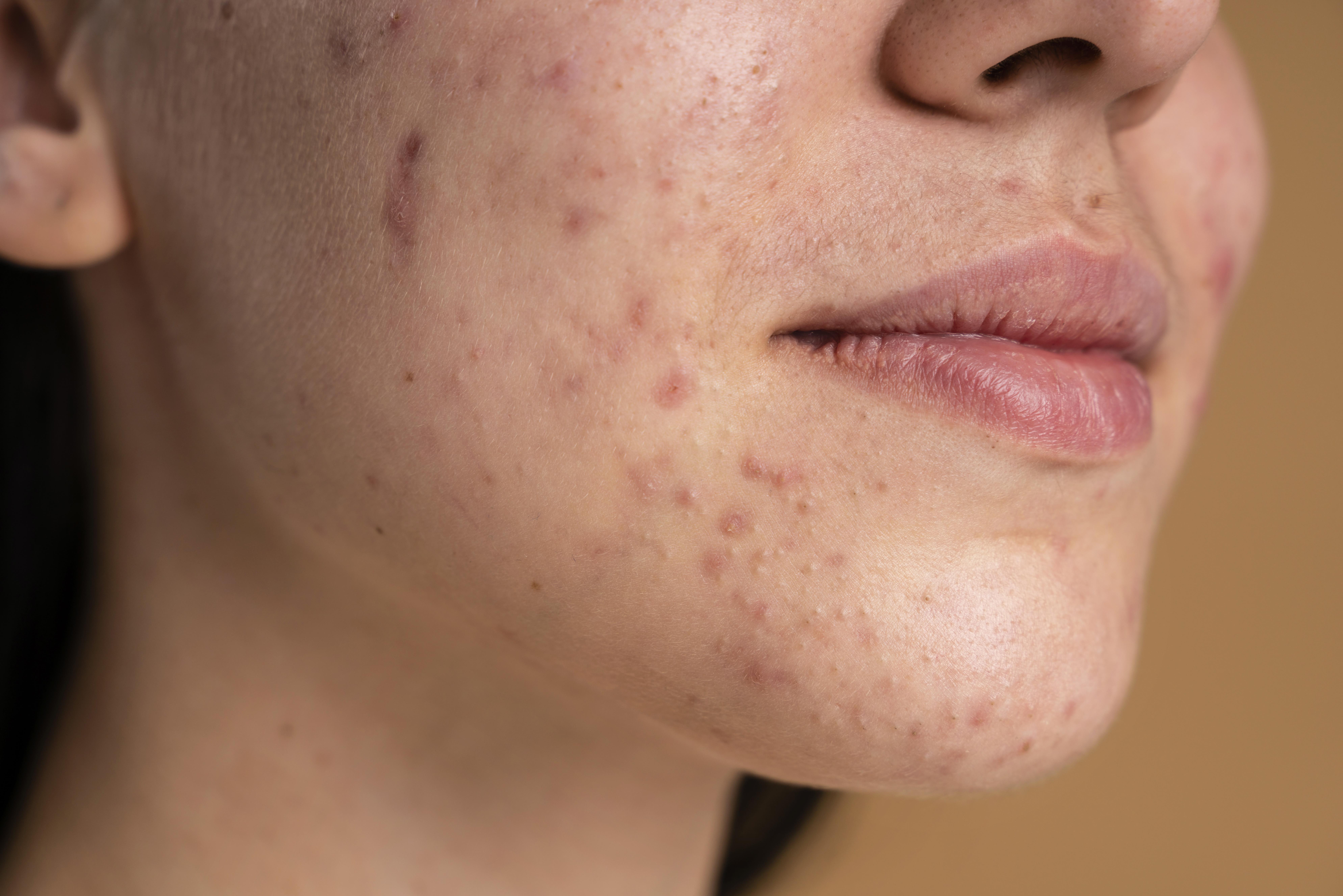 Homeopathic Treatment for Acne — Dr. Manish Yadav, Sevatwa Clinic