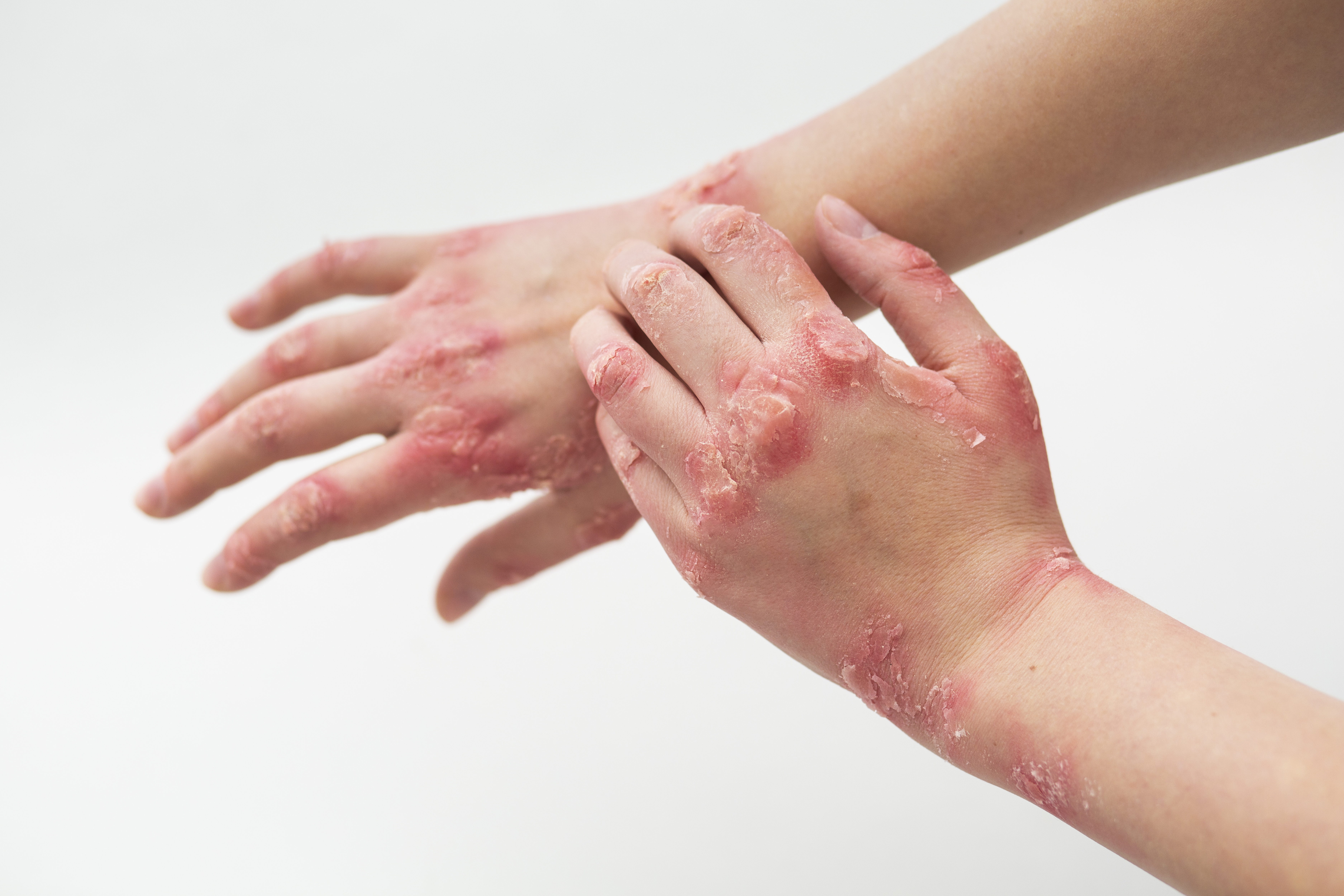 Homeopathic Treatment for Eczema — Dr. Manish Yadav, Sevatwa Clinic