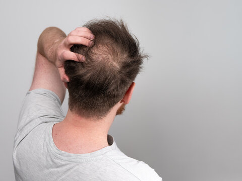 Homeopathic Treatment for Hair Loss — Dr. Manish Yadav, Sevatwa Clinic