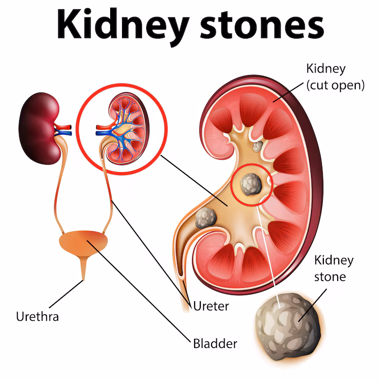 Homeopathic Treatment for Kidney Stone — Dr. Manish Yadav, Sevatwa Clinic