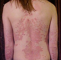 Homeopathic Treatment for Psoriasis — Dr. Manish Yadav, Sevatwa Clinic
