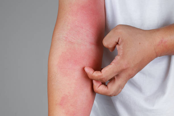 Homeopathic Treatment for Skin Rash — Dr. Manish Yadav, Sevatwa Clinic